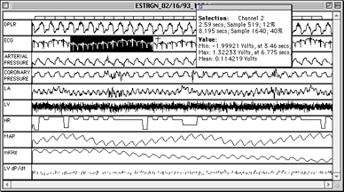 Picture11-orig-ecg-sel-sm.gif